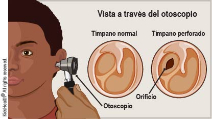 Vista de un t?mpano normal y de un t?mpano perforado