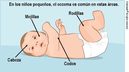 En los ninos pequenos, el eccema es comun en estas areas.
