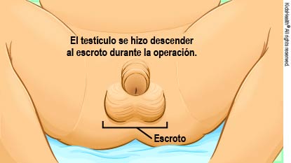 Durante la operación, el testículo no descendido se hace descender al escroto.
